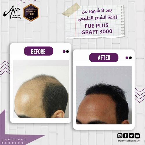 تكلفة زراعة الشعر في مصر 2024